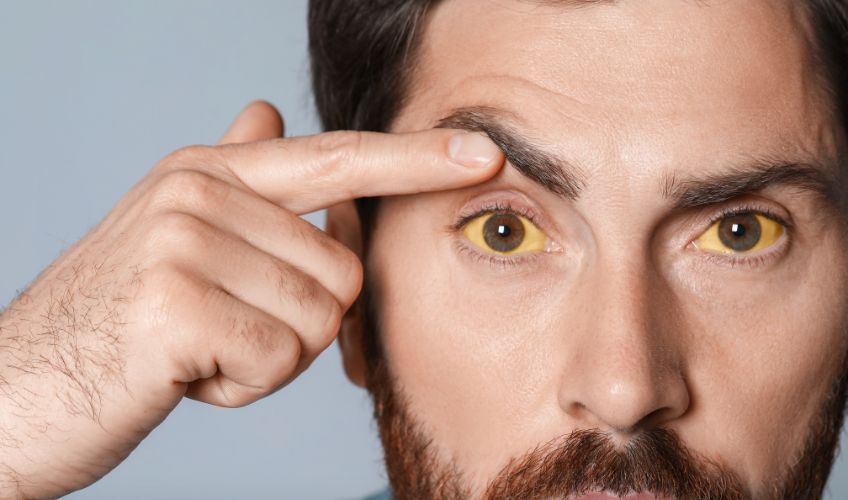 Xanthelasma